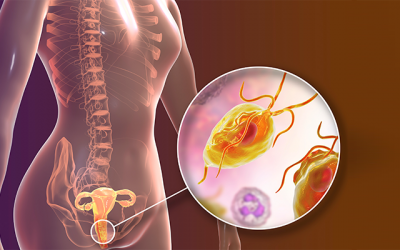 ¿Podemos prevenir la cervicitis?